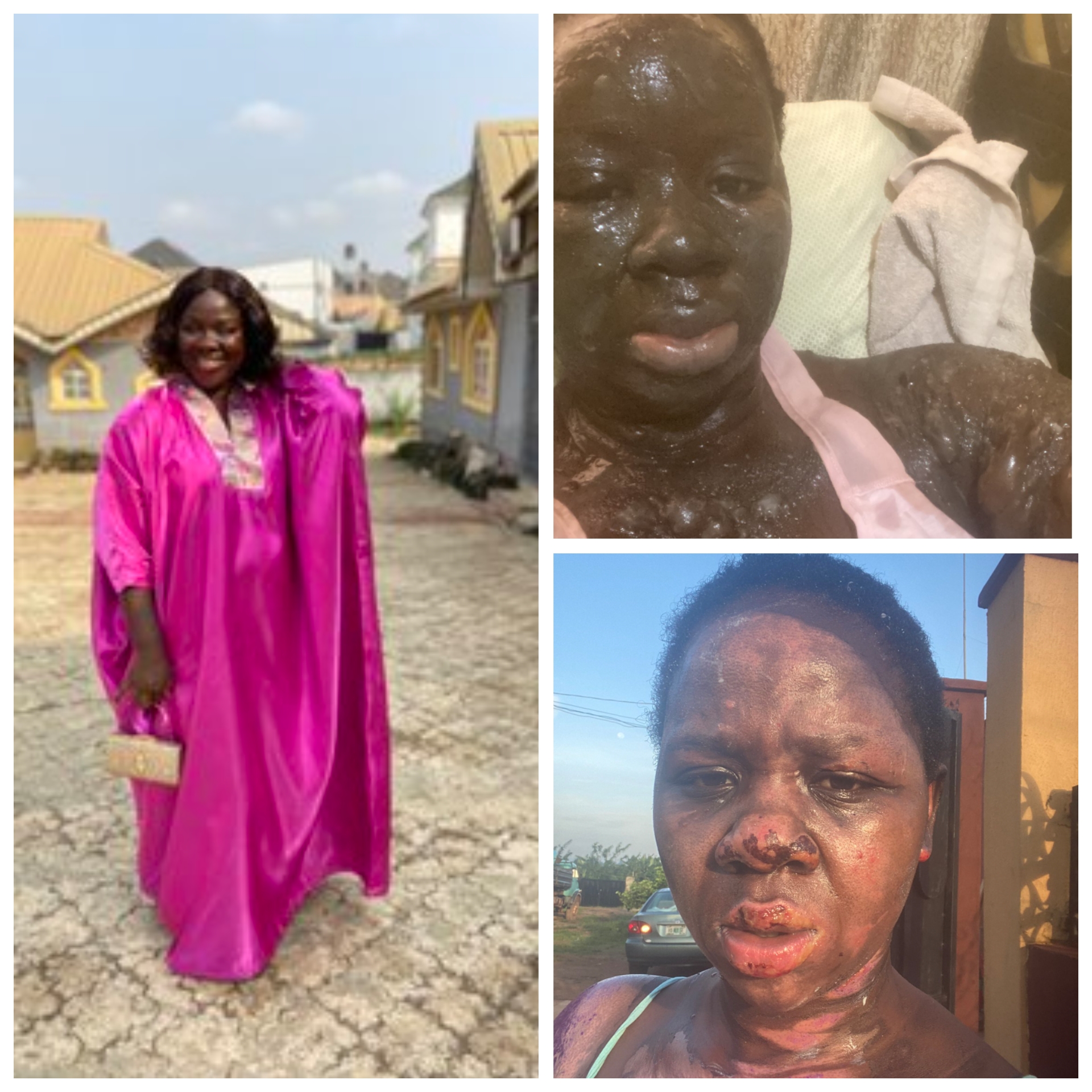 Nigerian burn survivor shares photos after surviving gas explosion