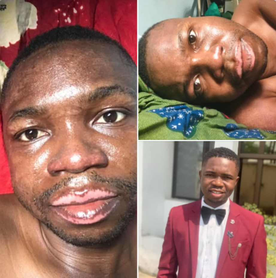 Nigerian man marks three years since surviving gas explosion